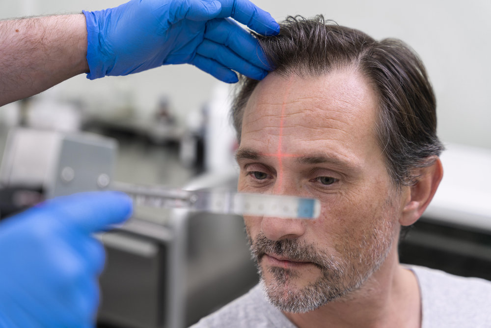 Dentist Cape Town | Hair Restoration Treatment
