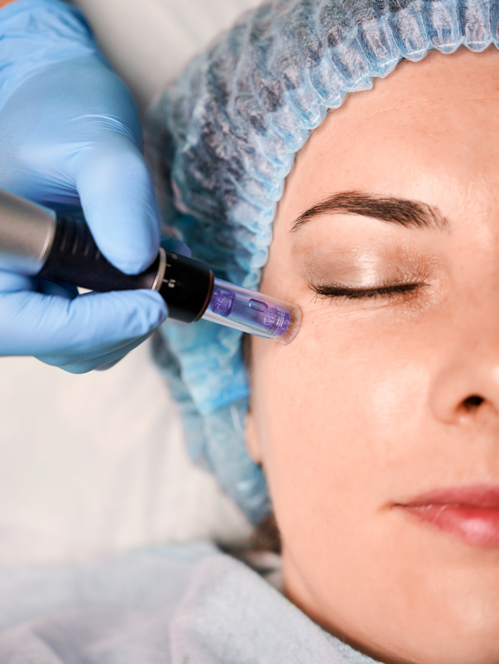 Dentist Cape Town | Microneedling