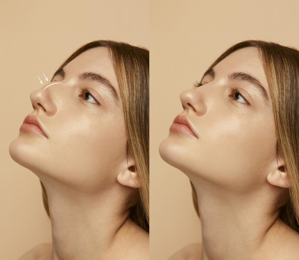 Dentist Cape Town | Non-Surgical Rhinoplasty